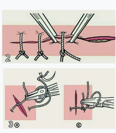 Как правильно зашивать рану